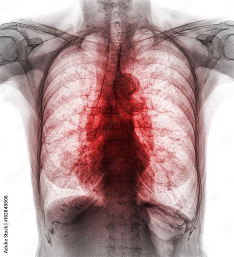 Pulmonary Tuberculosis . Film chest x-ray show interstitial infiltrate ...