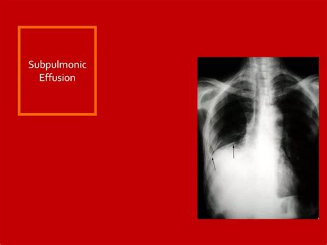 27 Dr Ahmed Esawy Imaging Oral Board Of Chest Imaging Chest Wall