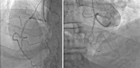 On The Left Rca Angiogram Anteroposterior Projection With Cranial