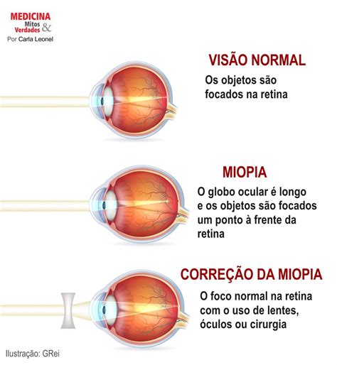 São Formas De Reconhecimento Dos Sinais De Problemas Ocular Exceto