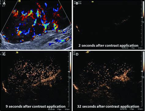 Contrast Enhanced Ultrasonography Ceus Image Of A Canine Mammary