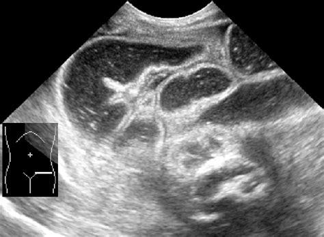 Ileal Atresia Image