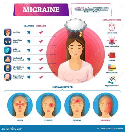 Migraine Vector Illustration. Labeled Headache Triggers And Types ...