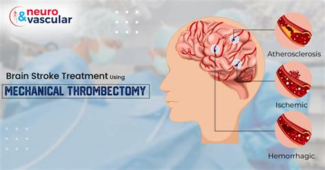 Brain Stroke Treatment using Mechanical Thrombectomy