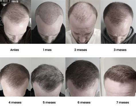 Hair Transplant Recovery Day 1 To 12 Months Easyhairhub