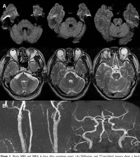 Figure 1 from Transient Upbeat Nystagmus Due to Unilateral Pontine ...