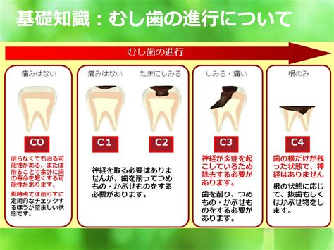 宮崎歯科医院｜ 虫歯の進行と処置