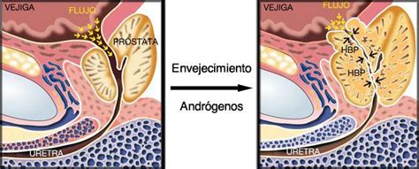 Benign prostatic hyperplasia Centro Gil Vernet de Urología