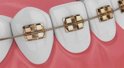 Arcos De Ortodoncia Usos Y Caracter Sticas Dentaltix