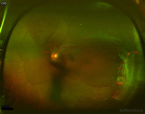 Sickle Cell Retinopathy