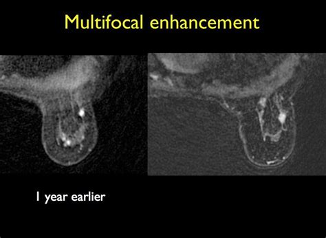 Breast MRI: Quick and Easy | ELS