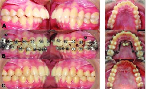 Comparison Photographs A Pretreatment Intraoral Photographs B