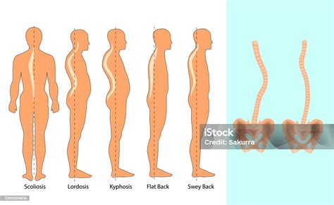 Ilustrasi Vektor Jenis Kelainan Bentuk Tulang Belakang Skoliosis