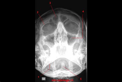 Paranasal Sinuses Radiography W Radiology