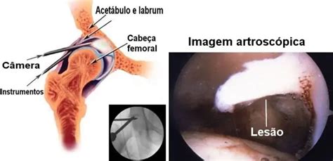 Artroscopia De Quadril Traumatologia E Ortopedia