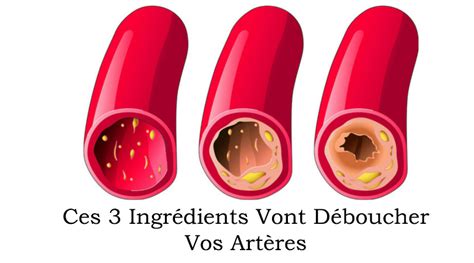 Nettoyage des artères coronaires avec seulement 3 ingrédients Santé