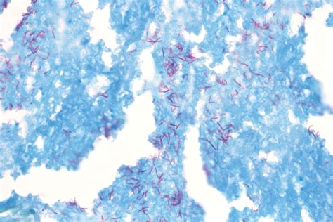 Mycobacterium Tuberculosis Acid Fast Stain