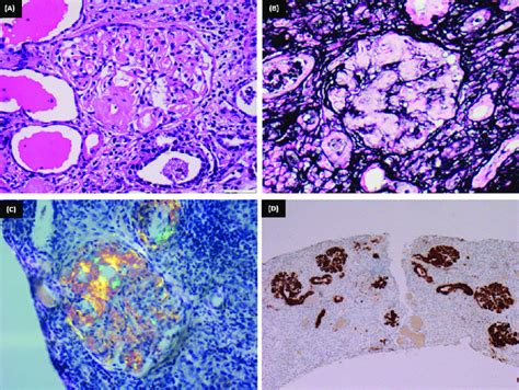 A Glomerulus Shows A Abundant Mesangial As Well As Capillary Wall