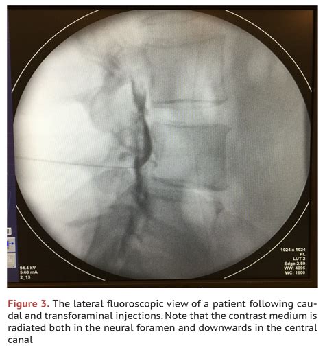 EVALUATION OF THE EFFICACY OF PERCUTANEOUS CAUDAL AND COMBINED CAUDAL ...