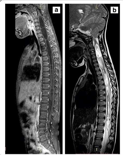 A Sagittal T1 Weighted Sequence Of Mri Of Thoracolumbar Spine Showing