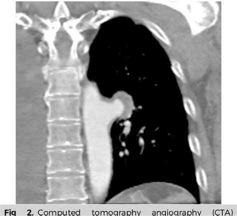 Figure 2 From Treatment Of A Descending Thoracic Mycotic Aneurysm