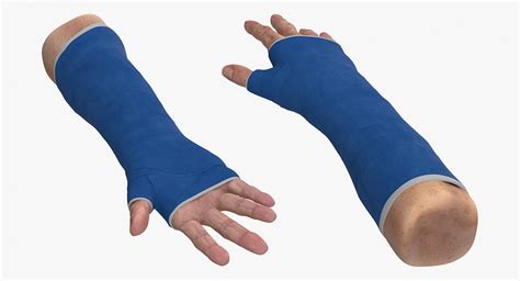 3D Fiberglass Cast Wrist | 3D Molier International