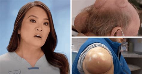 What Are The Biggest Pops On Dr Pimple Popper Meaww