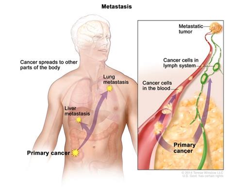 Definition of metastasize - NCI Dictionary of Cancer Terms - NCI