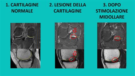 Osteocondrite Dissecante Del Ginocchio Alberto Grassi