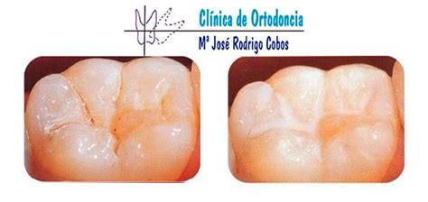 Selladores de fosas y fisuras Clínica de Ortodoncia