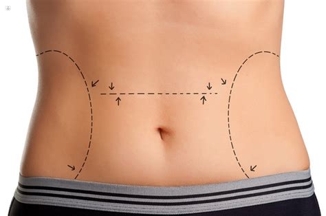 Diferencias Entre Liposucci N Y Abdominoplastia Top Doctors