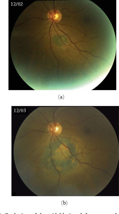 Figure From Bilateral Diffuse Uveal Melanocytic Proliferation