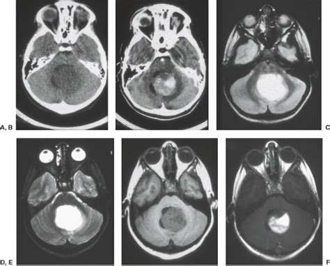 Pediatric Brain Tumors Radiology Key