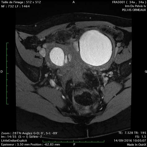 Le diagnostic de l endométriose IFEM Endo