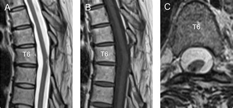 Intramedullary Cavernous Hemangioma Of The Spinal Cord With Intra And