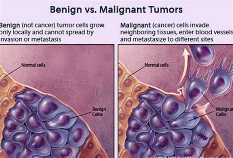 Science Tumors: Benign vs. Malignant Diagram | Quizlet 