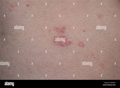 Vesicular Rash Shingles