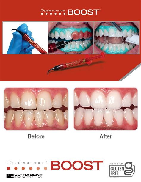 OPALESCENCE BOOST PATIENT KIT