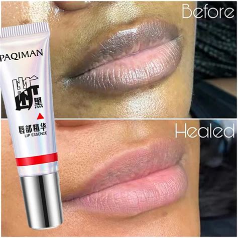 Lips Pink Fresh Lightening Bleaching Cream Treatment Remove Dark Smoke Lips Essence Lips