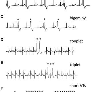 A) single premature ventricular beat; B) trigeminy complexes; C ...