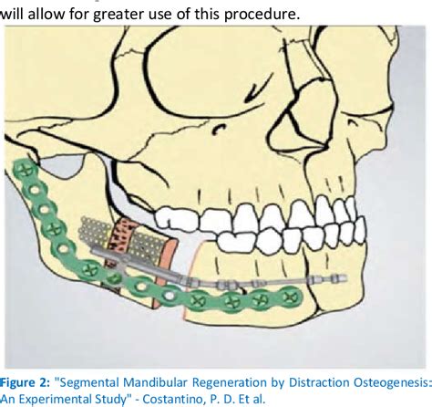 Figure From Mandibular Reconstruction A Review Semantic Scholar