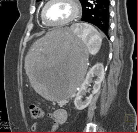 Ulcerating Gastric GIST Tumor / CTisus.com | Stomach, Radiology imaging ...