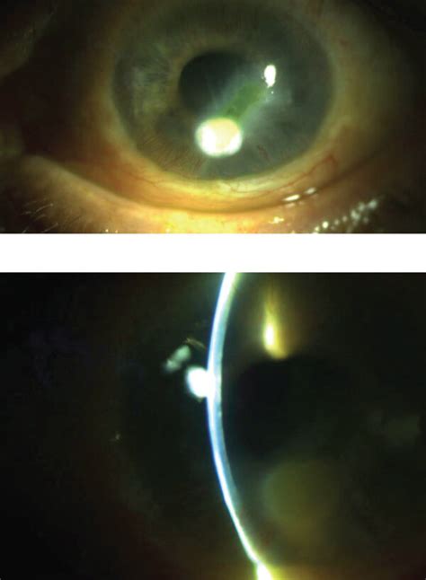 Bacterial keratitis at presentation. | Download Scientific Diagram