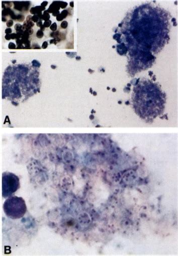 Use Of A Rapid Differential Stain For Identifying Pneumocystis Carinii In Bronchoalveolar Lavage