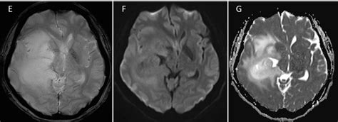 Diffuse astrocytoma – Radiology Cases