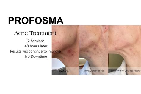 Profosma Jet Plasma Skinrx Aesthetic Clinic Pty Ltd