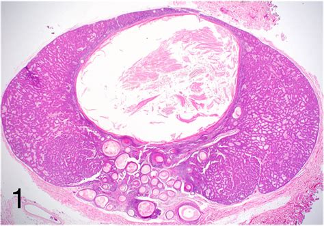 Panfolliculoma In Sufu Mutated Basal Cell Nevus Syndrome Jaad Case