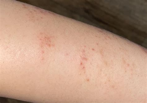 Could this be a gluten rash? Was eating gluten my entire life with no