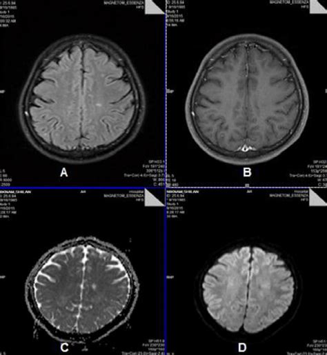 A tiny active MS plaque in subcortical white matter in parietal lobe ...