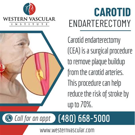 Carotid Artery Endarterectomy Artofit